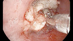 Местастаз левого главного бронха